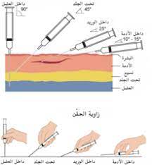 Can also be taught by taleron in berg for 50 silver. Ø­Ù‚Ù† Ø·Ø¨ ÙˆÙŠÙƒÙŠØ¨ÙŠØ¯ÙŠØ§