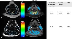 Maybe you would like to learn more about one of these? Muscle Fat Infiltration Following Whiplash A Computed Tomography And Magnetic Resonance Imaging Comparison