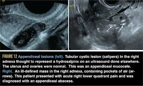 1 nearly 75% of women with currently, there is no consensus opinion on the use of doppler ultrasound for the differentiation between benign and malignant ovarian masses. Gynecologic Ultrasound Primer How Not To Miss The Diagnosis