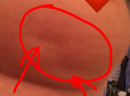 What's new in breast cancer research? Breast Cancer Patient Lisa Royle Posts Photo Of Subtle Dimples That Alerted Her To Illness The Independent The Independent