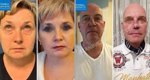 Be an image of 2 people and text that says 'i̇stanbul aesthetic plastic surgery. Istanbul Aesthetic Center In Turkey Prices Trusted Reviews Clinics On Call