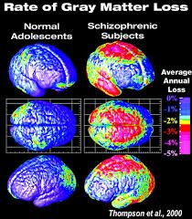 Effects on the brain schizophrenia is a disease that affects the brain. Imaging Studies Document Schizophrenia S Devastation Psychiatric News