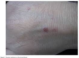 Image result for Pathergy