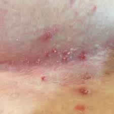 Intertrigo is caused when frictional forces, enhanced by heat and moisture, produce skin irritation.; Intertrigo Doccheck Flexikon
