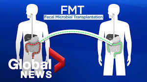 Image result for Fecal Transfer