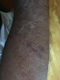 This condition is observed worldwide and has nothing to do with race or ethnic background. Bateman S Purpura Purple Blotches Bruising Of Hands And Forearms Disabled World