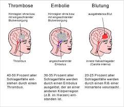 Die klinischen symptome der sinusvenenthrombose sind: Neurologische Krankheitsbilder Pdf Kostenfreier Download