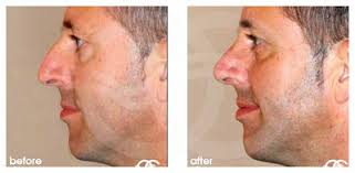 Hair loss is a symptom. How To Fix The Bump In Your Nose Oc Latest News