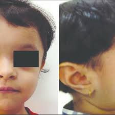 A 17 Month Old Girl Presented With Below Average Height And