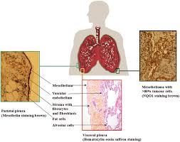 These reactions are called symptoms. Malignant Pleural Mesothelioma History Controversy And Future Of A Man Made Epidemic Springerlink