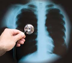 In etapa 2 de vindecare, de obicei, apare mancarimea. Pneumonia Simptome Tratament