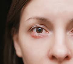 How To Get Rid Of A Stye Safely & Properly
