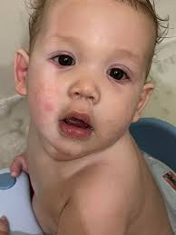 Mommas could this possibly be allergy related? He's almost 8 months old and  is