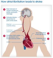 Pin On A Fib And Stroke Visualized