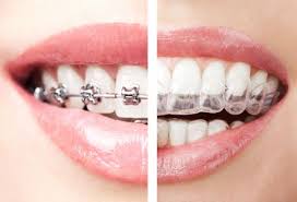 Invisalign Vs Traditional Braces If You Are Looking To Have Your Teeth Straightened Invisalign Invisalign Dentist Dental Braces