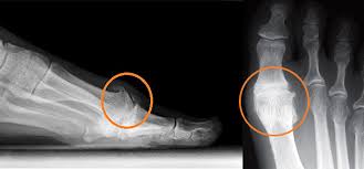 This commission doesn't affect products prices. Hallux Limitus Big Toe Joint Arthritis St Catharines Ontario Canadian Foot Clinic Orthotic Centre