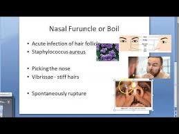 Find out if a staph infection is contagious, learn how a staph infection is transmitted, incubation period and discover when to seek medical care for a suspected staph infection. Ent Nasal Furuncle Hair Follicle Furunculosis Nose Boil Youtube