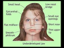 The affected individuals are mentally retarded (mildly to moderately) and suffer from congenital heart defects with a very high (1/100) risk of acute leukemia. Fetal Alcohol Syndrome Youtube