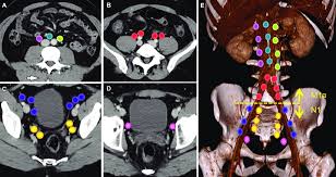 Prostate cancer with local metastasis means that the cancer has spread to other organs within the pelvis, which usually means the nearby lymph nodes. Typical Nodal Spread Pattern Of Prostate Cancer Arising From Caudal Download Scientific Diagram