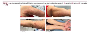 Image result for Atopic Patient