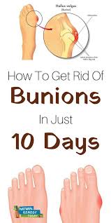 Bunions Bunions Remedy Get Rid Of Bunions Bunion Exercises Bunion Natural Remedies Bunion Products H Get Rid Of Bunions Bunion Cure Bunion Remedies