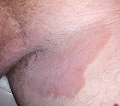 Image result for penis mycosis symptoms