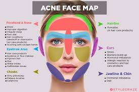 Acne Face Map What Is Your Acne Trying To Tell You Acne