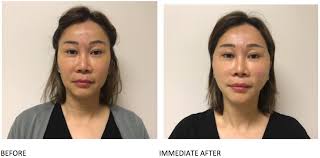 Asian blepharoplasty, or double eyelid surgery deals with several kinds of upper lid procedures, but the primary focus is the upper eyelid crease. Mint Pdo Thread Lift Minimally Invasive Non Surgical Thread Lift Using Pdo Threads Serenity Medspa