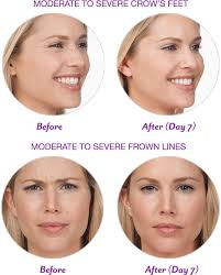 Botox Cosmetic Onabotulinumtoxina Official Site Welcome Botox Cosmetic Botox Medical Skin Care