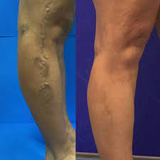 Compression Stockings Why Do I Need To Wear Them After Treatment