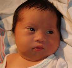 Down Syndrome And Neonates Better Safer Care
