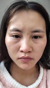 Who does the best fillers...botox etc.? Doctor please!!!!