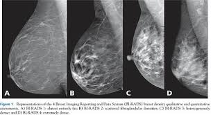 People should become familiar with the typical look and feel of their. The Problem With Mandatory Breast Density Reporting Laws Scienceblogs