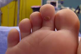 How To Overcome Clavus Fisheye Disease Overcoming Disease Prevention