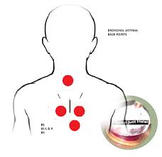 Bronchial Asthma Hijama Cupping Points Cupping Therapy Hijama Cupping Points