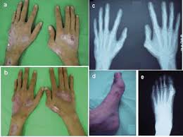 Tuberculosis verrucosa cutis (tbvc) was once seen in 65.5% of the childhood cases from hong kong, it is an uncommon form of the disease in indian introduction: Long Lasting Scrofuloderma Of Hands And Foot Html Acta Dermato Venereologica