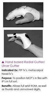Image result for Radial Gutter Cast