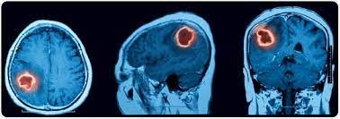 Un'emorragia cerebrale è un versamento ematico all'interno del cranio. Cause Dell Emorragia Intracerebrale Ich