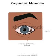 Image result for conjunctival melanoma