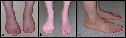 Crush videos are banned in both britain and the united states. Immunotherapy Prospects For Painful Small Fiber Sensory Neuropathies And Ganglionopathies Springerlink