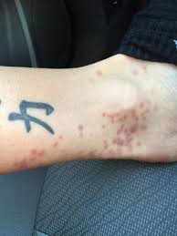 Scientists call these creatures trombiculid mites. but they have a bunch of nicknames. Chigger Bites Picture Of Sandals Montego Bay Jamaica Tripadvisor