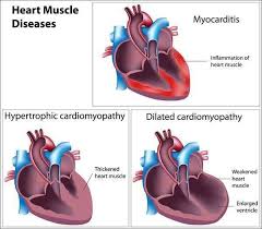 In both cases, the body's immune system is causing inflammation in response to an infection or some other trigger. Heart Muscle Diseases Myocarditis Hypertrophic Cardiomyopathy Dilated Cardiomyopathy Photo Curt Heart Muscle Muscle Diseases Hypertrophic Cardiomyopathy