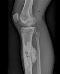 Image result for Osteosarcoma