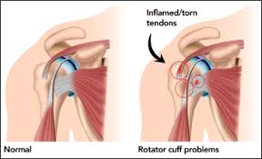 This condition may be treatable. Shoulder Impingement Syndrome Sis Pain Free Physiotherapy