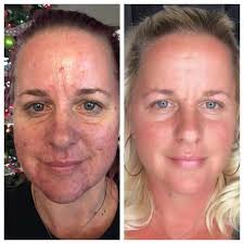 Before and after just ONE treatment of Microneedling.... my client has  rosacea and has gradually got worse year by year.... she was feeling so  insecure .... now just after one treatment it's