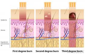 Check spelling or type a new query. What Is The Treatment For Third Degree Burns With Pictures