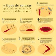 Sutura continúa en la que cada punto 
atraviesa perpendicularmente la herida,
en sentido opuesto al punto anterior.