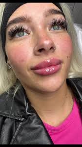 Before & after 1ml dermal lip filler today Harlohs Cosmetics &  Aesthetics👄👄💉