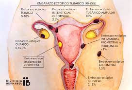 El Embarazo Ectopico