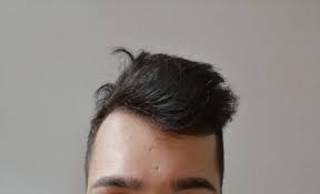 Bei starkem haarausfall ist auch ein komplett rasierter kopf eine option. Fallen Meine Geheimratsecken Stark Auf Frisur Friseur Haarausfall